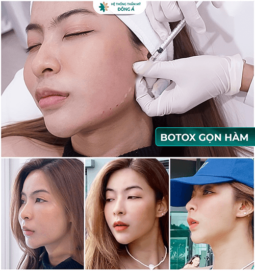 Tiêm Botox Thon Gọn Hàm Ưu Điểm và Nhược Điểm